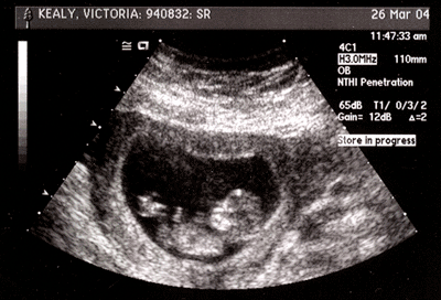 2nd Sonogram